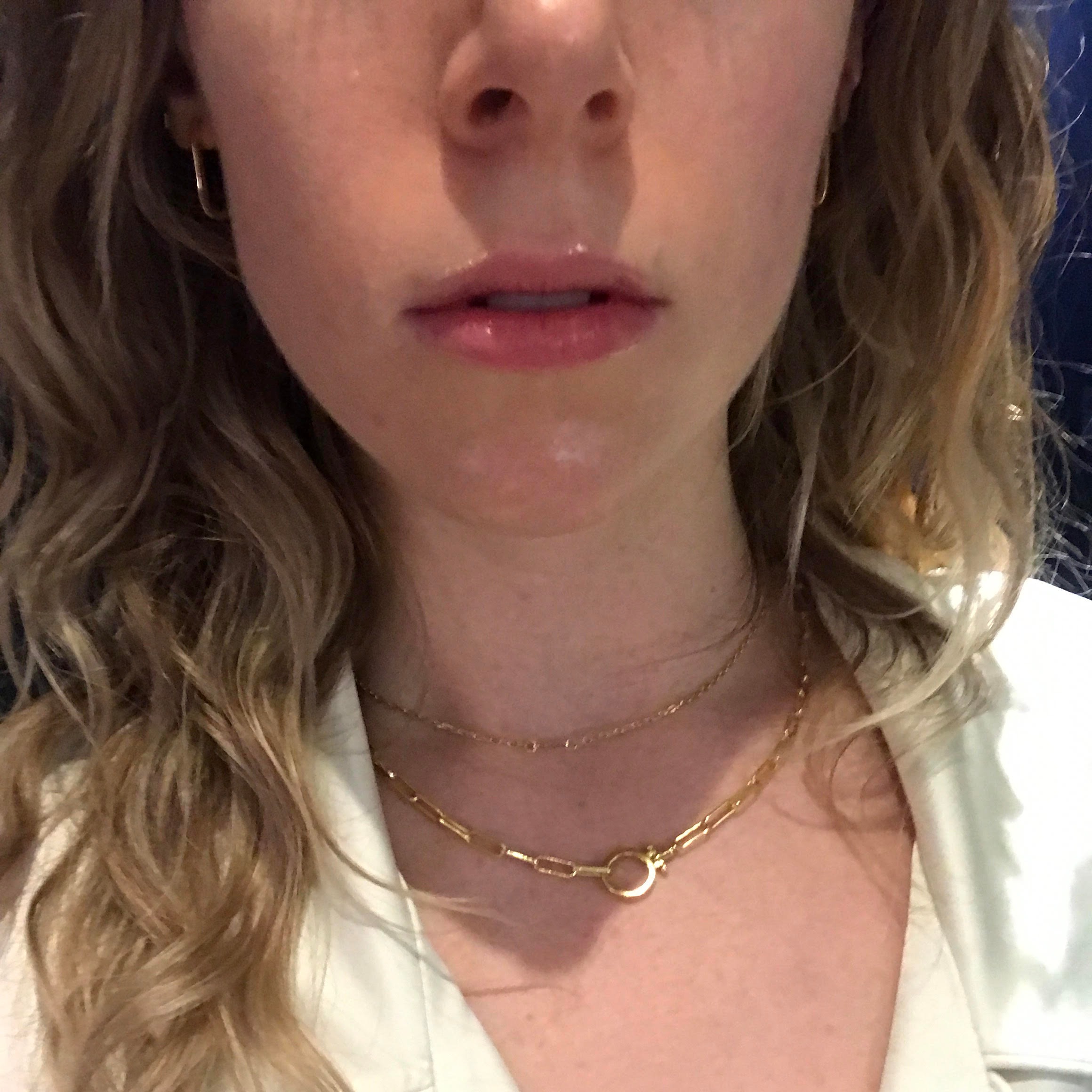 What It's Really Like To Get Lip Fillers